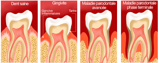 assainissement gencives