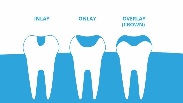 Inlays-and-Onlays-1-750x410