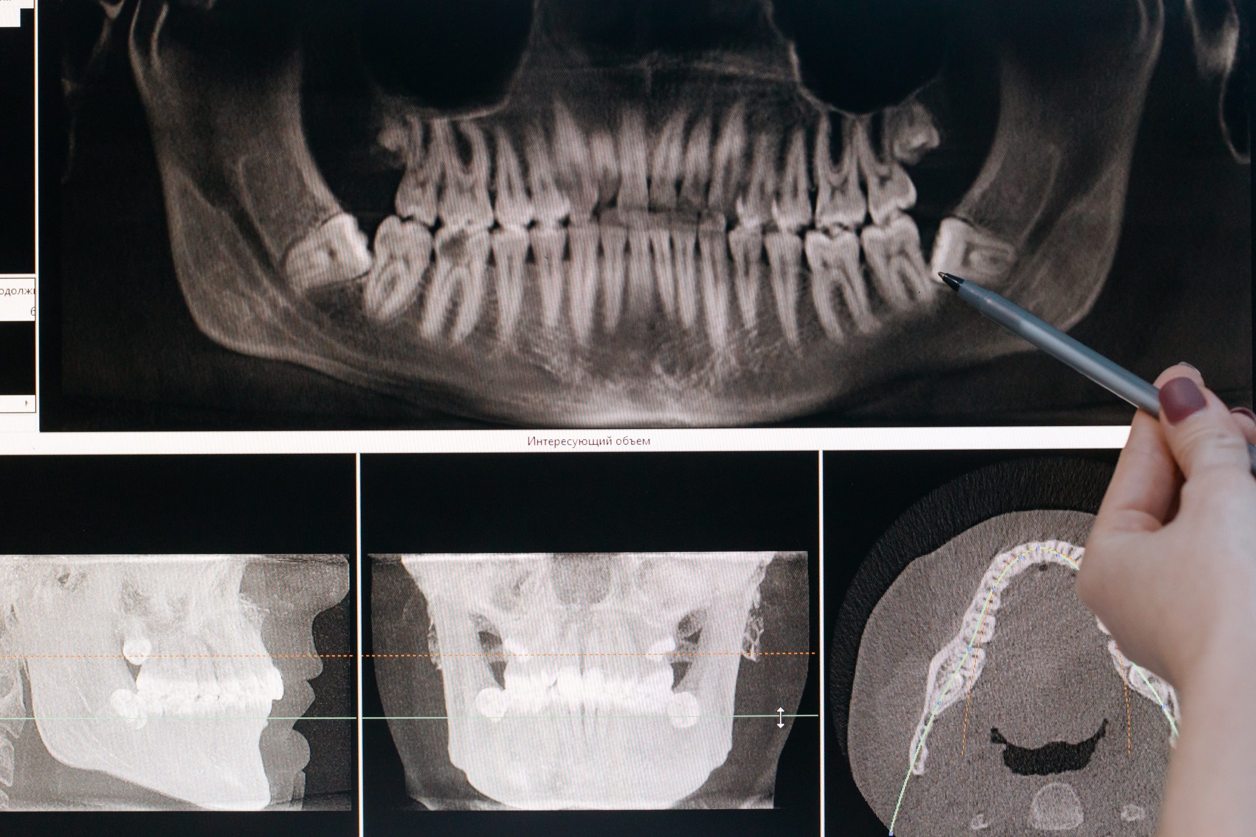 Comment cicatriser une dent arrachée ? | dentiste la defense