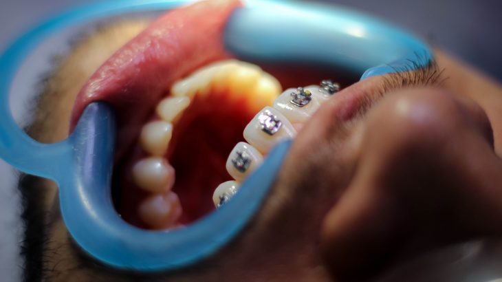 Orthodontie chirurgie avancée mandibulaire