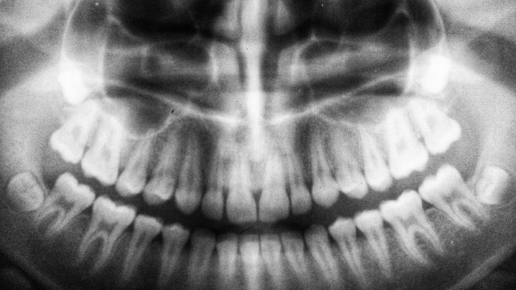 Avulsion dentaire risques chirurgicaux